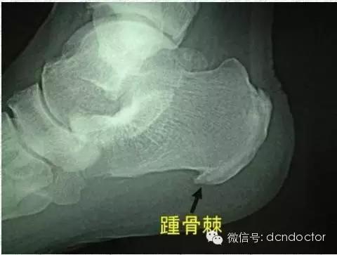 治足跟痛绝招,治足跟痛偏方视频