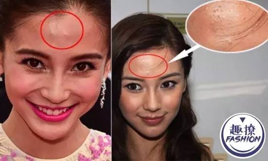 angelababy痘痘,angelababy额头冒巨痘