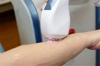 激光美白和激光脱毛,做完激光祛痣多久能做激光脱毛