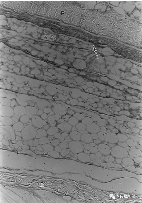 筋膜的润滑液——透明质酸