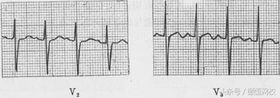 郭雅卿心电图讲解全集,郭雅卿血汗管视频课