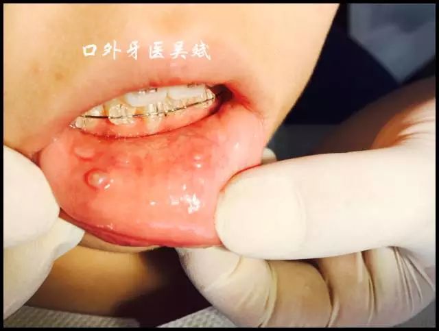 嘴里长疱怎么回事,嘴里起了好几个水泡怎么回事