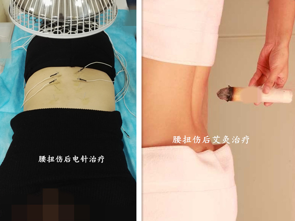 脚踝扭伤肿痛针刺放血,急性腰扭伤经方