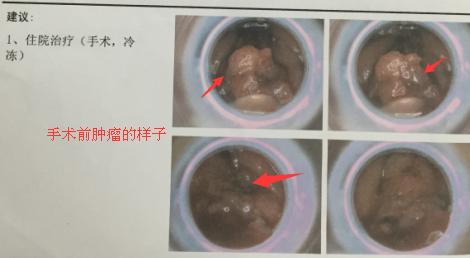 低位直肠癌保肛冷冻治疗多少费用,低位直肠癌患者保肛后存活率