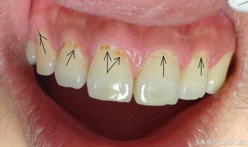 牙齿烂了只剩根部怎么拔掉,牙齿根部烂了怎么回事