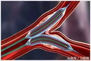 微创介入科一卫毅楠,什么是血汗管介入治疗