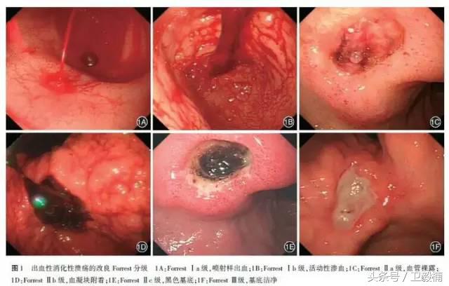 微创介入科一卫毅楠,什么是血汗管介入治疗