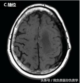 头顶长了包子似的疙瘩是什么,头顶长了个包是肿瘤吗