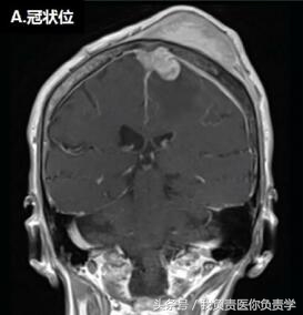 头顶长了包子似的疙瘩是什么,头顶长了个包是肿瘤吗