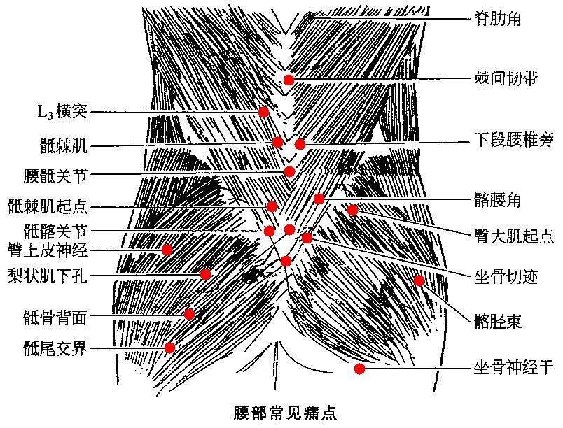 脚踝扭伤肿痛针刺放血,急性腰扭伤经方