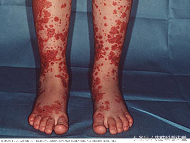 双小腿起红疹子是什么原因,双小腿出现有一片红点是什么原因