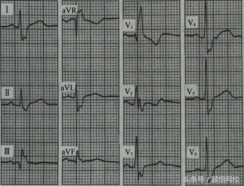 郭雅卿心电图讲解全集,郭雅卿血汗管视频课