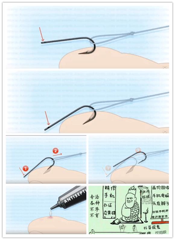 新手钓鱼怕被刺如何取钩,钓鱼钩扎到肉里怎么处理