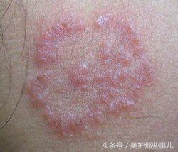 神经性皮炎激素药膏使用的两个“禁忌”