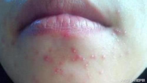 嘴周围下巴反复长痘痘怎么治疗,嘴唇及下巴周围出痘痘中医辨证