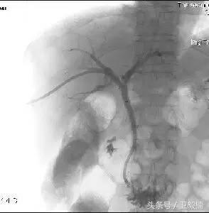 微创介入科一卫毅楠,什么是血汗管介入治疗