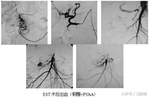 微创介入科一卫毅楠,什么是血汗管介入治疗