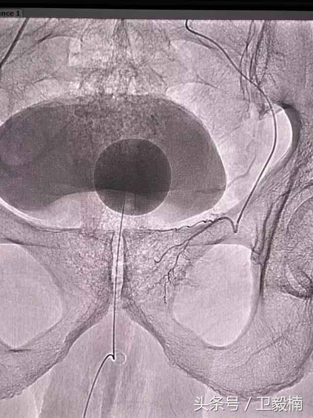 微创介入科一卫毅楠,什么是血汗管介入治疗