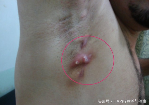 身上起了个包有臭味,身上起好多包是什么虫子