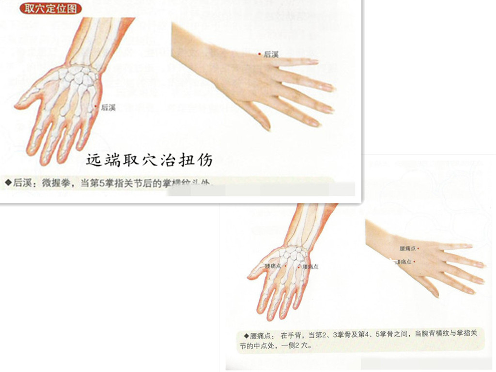 脚踝扭伤肿痛针刺放血,急性腰扭伤经方