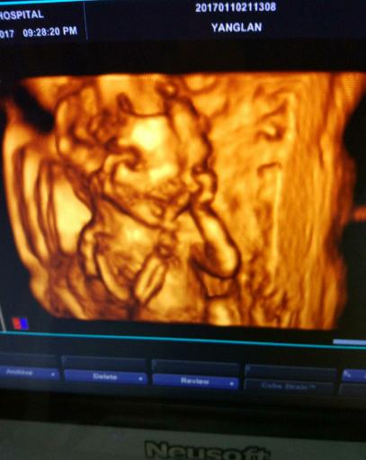 宝宝四维顺利通过腿短,宝宝四维顺利