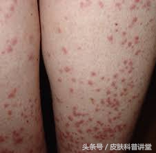 妊娠期瘙痒症出现皮疹怎么办,妊娠期皮肤瘙痒