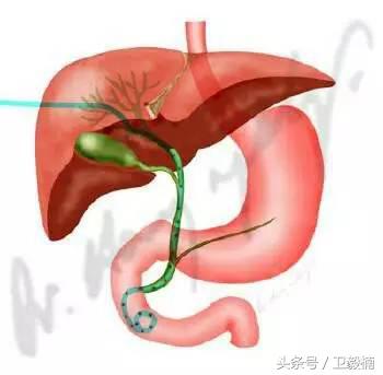 微创介入科一卫毅楠,什么是血汗管介入治疗