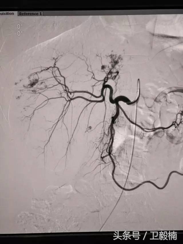 微创介入科一卫毅楠,什么是血汗管介入治疗