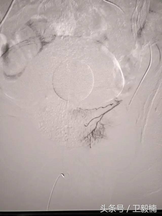 微创介入科一卫毅楠,什么是血汗管介入治疗