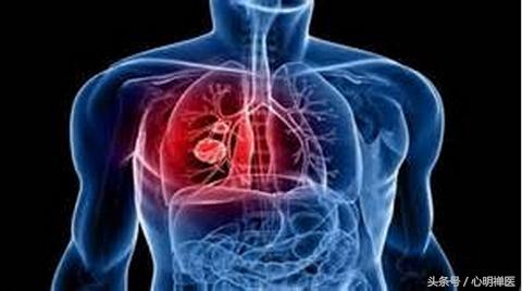 这些都是癌症早期的表现你却不当回事