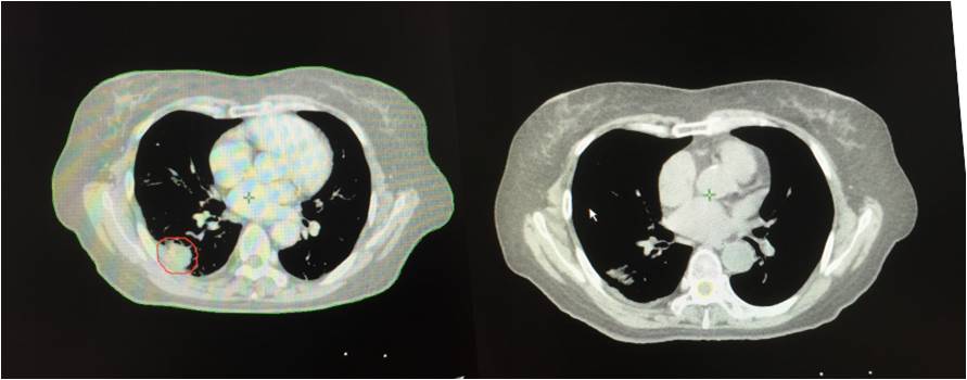晚期肿瘤治疗最新疗法,肿瘤治疗新利器