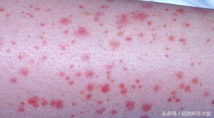 双小腿起红疹子是什么原因,双小腿出现有一片红点是什么原因