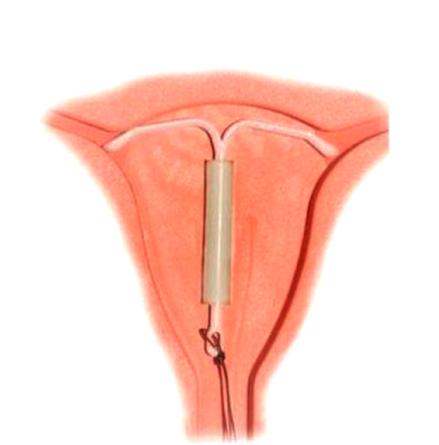 上环的危害真的很大吗,关于上环真的那么可怕吗