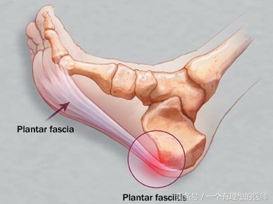 跟骨痛的康复训练方法,跟骨痛的封闭疗法