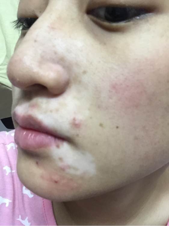 白斑光照,白斑光照后图片