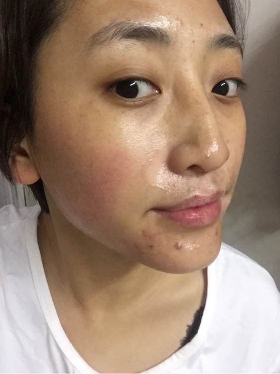 白斑光照,白斑光照后图片