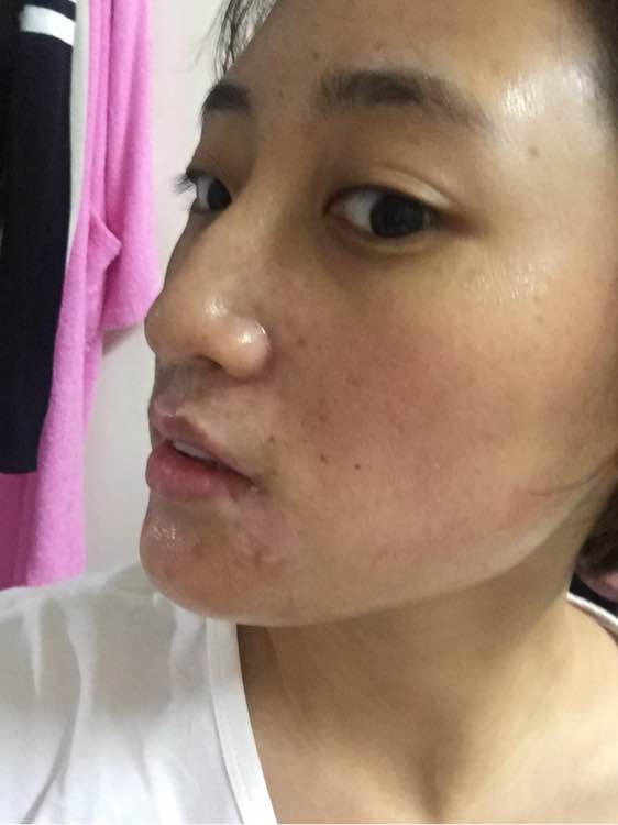 白斑光照,白斑光照后图片