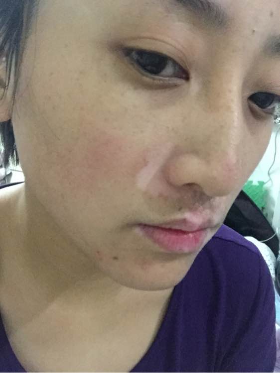 白斑光照,白斑光照后图片