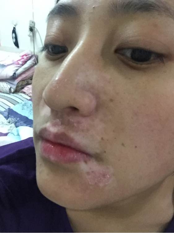 白斑光照,白斑光照后图片