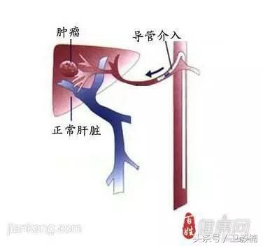 微创介入科一卫毅楠,什么是血汗管介入治疗