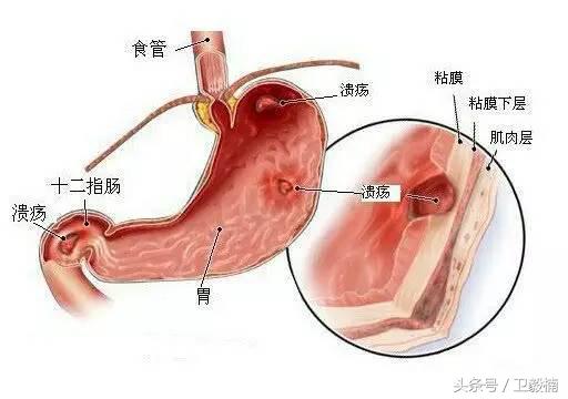 微创介入科一卫毅楠,什么是血汗管介入治疗