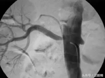 微创介入科一卫毅楠,什么是血汗管介入治疗