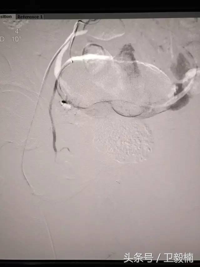 微创介入科一卫毅楠,什么是血汗管介入治疗