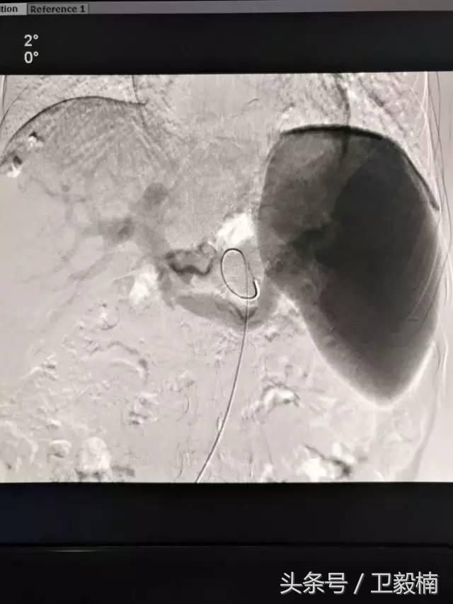 微创介入科一卫毅楠,什么是血汗管介入治疗