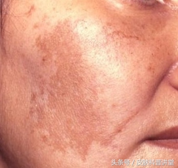 褐青色斑平时要关注什么,长褐斑是什么原因