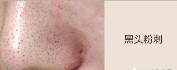 简单又有效的祛黑头方法，今天才是实在的方法