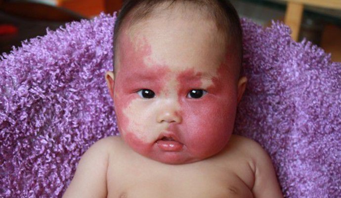 有没有治疗胎记特效药一天治好,胎记是夏天治疗好还是冬天治疗好