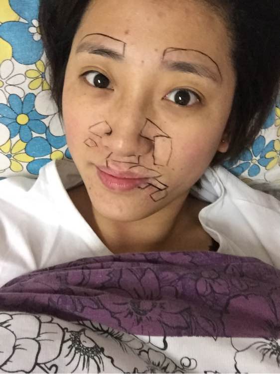 白斑光照,白斑光照后图片