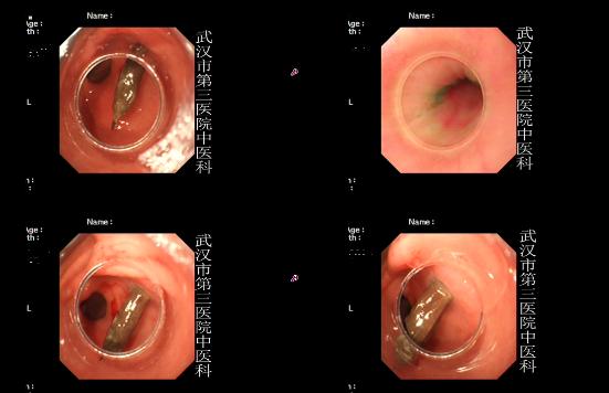 胃穿孔真的是胃上出现洞了吗,胃穿孔是腹部慢慢变硬吗