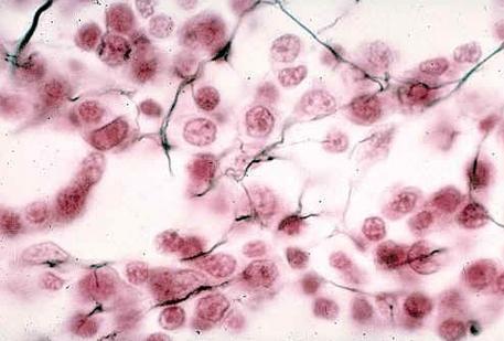 结缔组织病前兆,结缔组织病50岁死亡率高吗